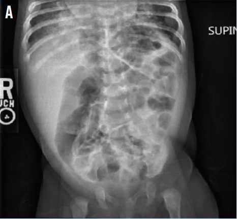 opacities in both lower lungs