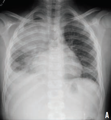 right upper lobe consolidation