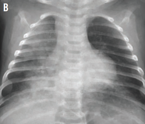 abnormal multifocal airspace opacifications