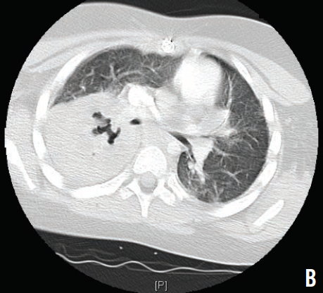 necrotizing right lung pneumonia with diffuse pneumonitis