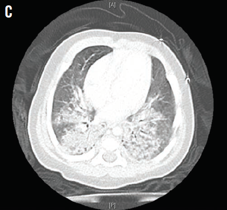 Patchy alveolar infiltrates