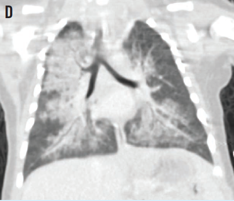 relative sparing of the left upper and right middle lobes