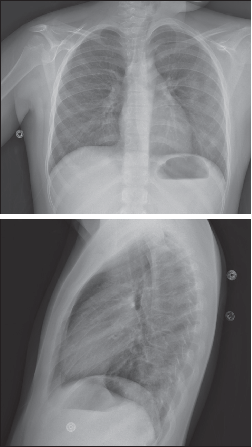 Figure 1 ‒ Posteroanterior and lateral chest films show bilateral increased interstitial markings, with no focal consolidation.