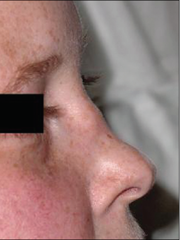 Figure 3 – Saddlenose deformity is shown here in another patient with Wegener granulomatosis.