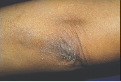 Xanthomas on the elbow