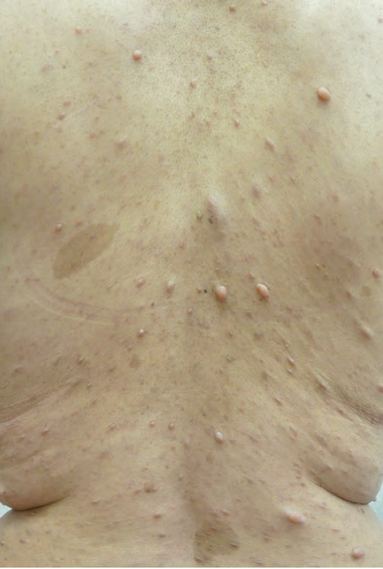nodules on a 54-year-old woman