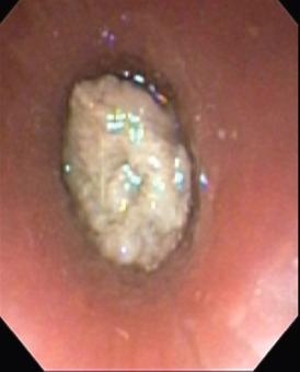 Bronchoscopy image showing a mass in the left main bronchus.