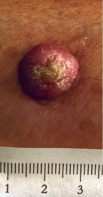 A Truck Driver With a Skin Lesion on His Upper Arm