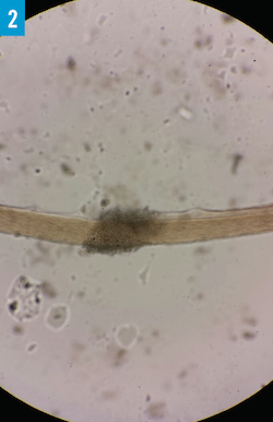 White piedra figure 2