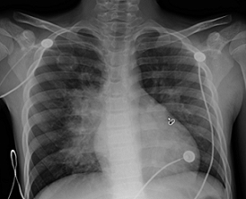 chest xray