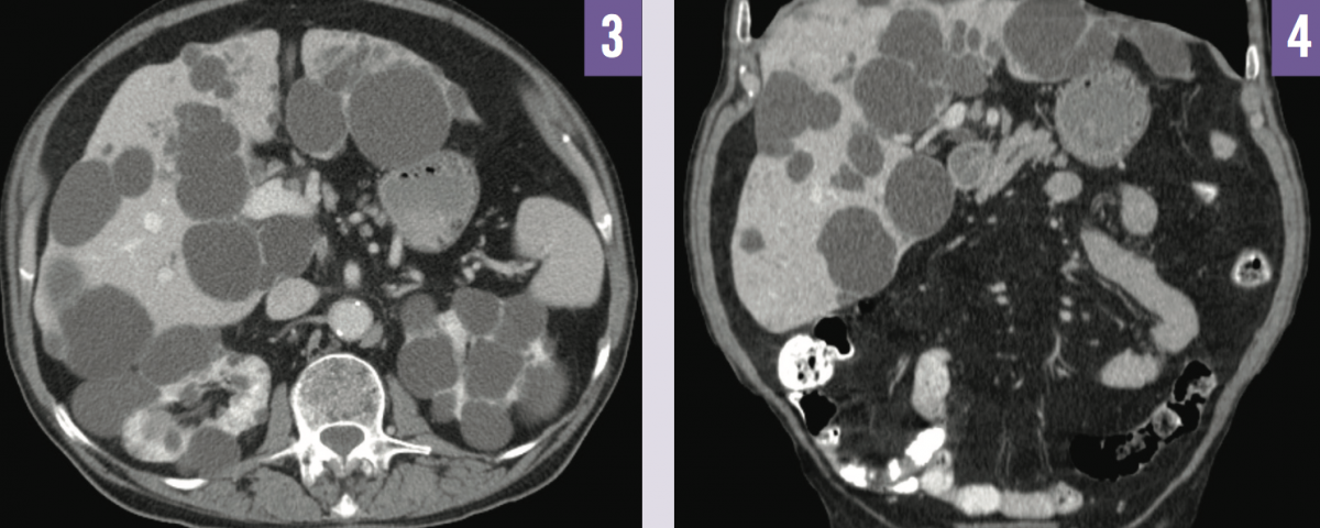 Autosomal Dominant Polycystic Kidney Disease