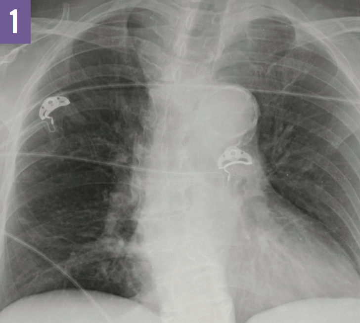 Tuberculosis Ileitis