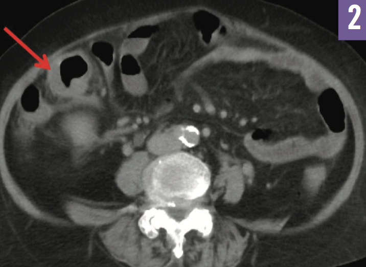 Tuberculosis Ileitis