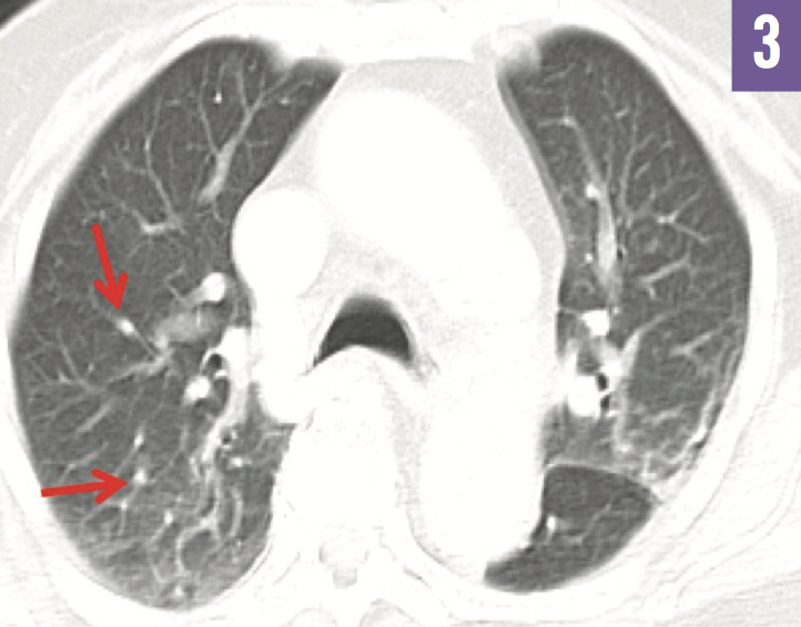 Tuberculosis Ileitis