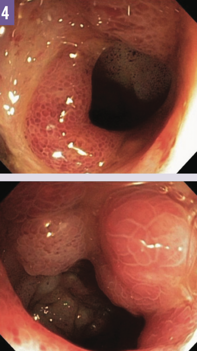Tuberculosis Ileitis