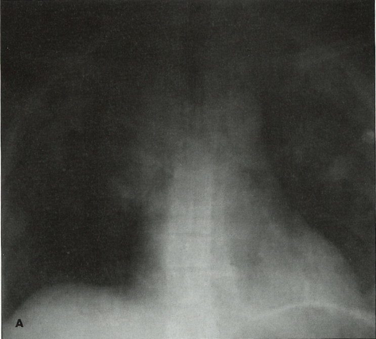 progressive dyspnea figure A