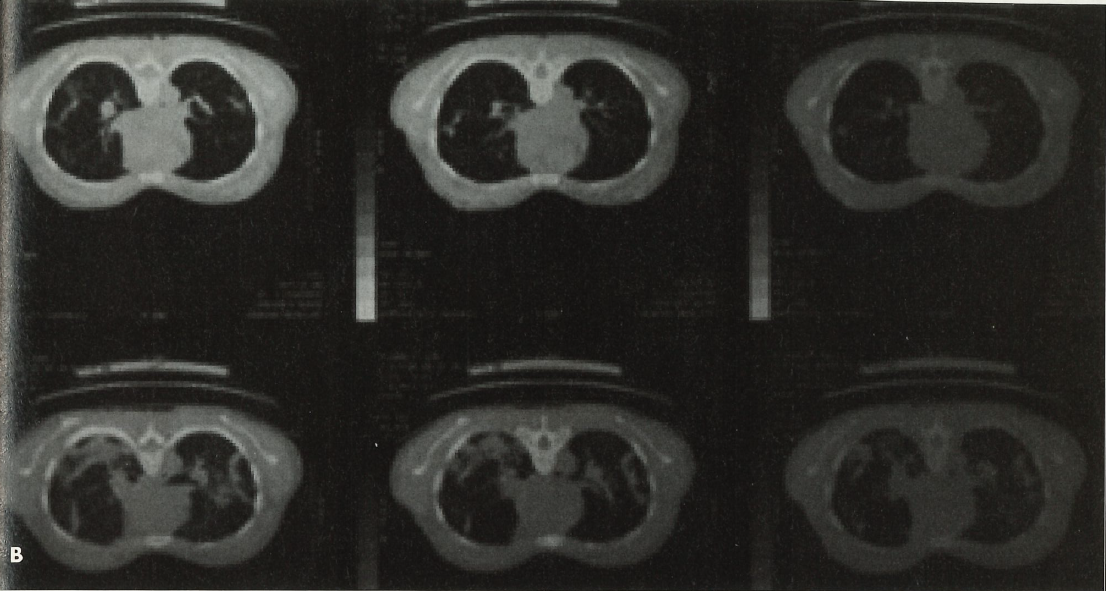 progressive dyspnea figure B