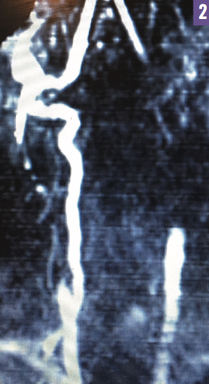 ubclavian steal syndrome 