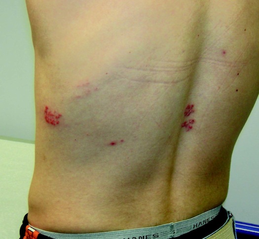 HZ meningitis figB