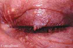 Acrochordon