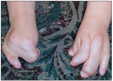 Apert Syndrome