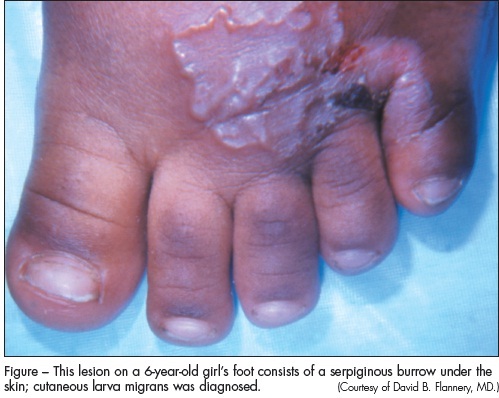 Cutaneous larva migrans