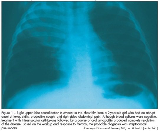 consolidation in 2-year-old girl with Streptococcal pneumonia