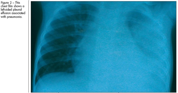 left-sided pleural effusion associated with pneumonia