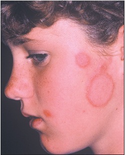 tinea faciei