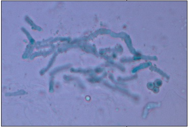 Malassezia furfur