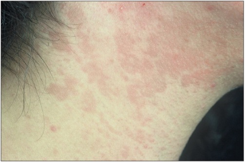 Tinea Versicolor