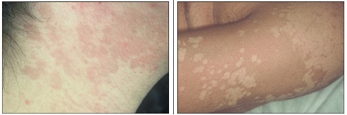 Tinea Versicolor