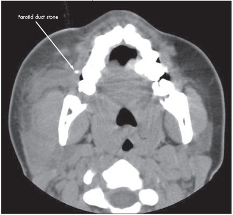 SIALOLITHIASIS WITH SIALOADENITIS