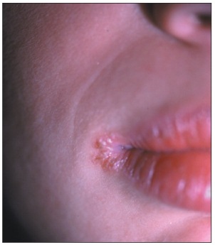 angular cheilitis