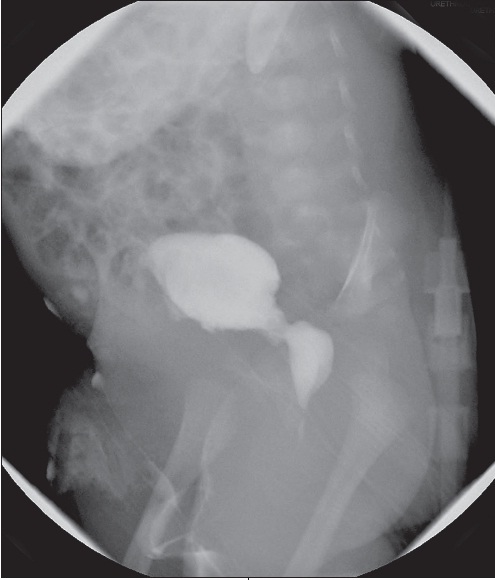 posterior urethral valves