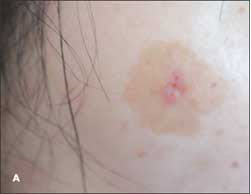 Lentigo | Consultant360