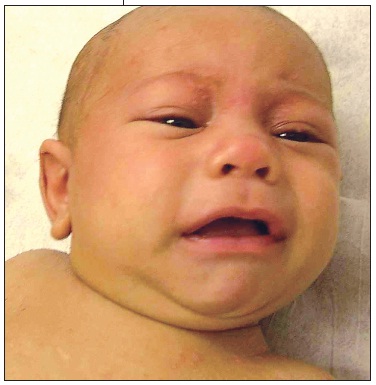 Langerhans cell histiocytosis 