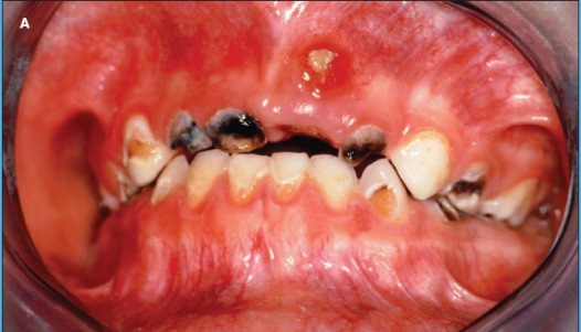 Figure A Dental Disease