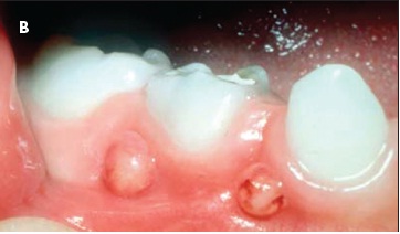 Figure B Dental Disease