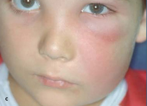 Figure C Dental Disease