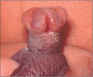 Coronal hypospadias