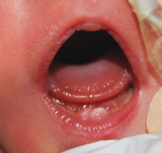 Neonatal Teeth