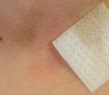 surface debris mistaken for rash