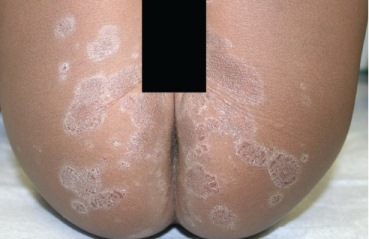 Pityriasis Rosea