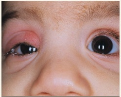 Chalazion