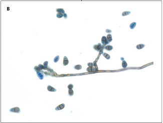 Allergic Fungal Sinusitis