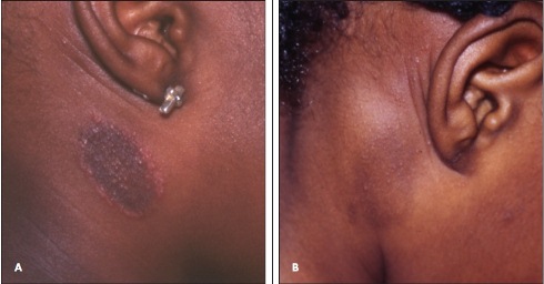 Postinflammatory Hyperpigmentation