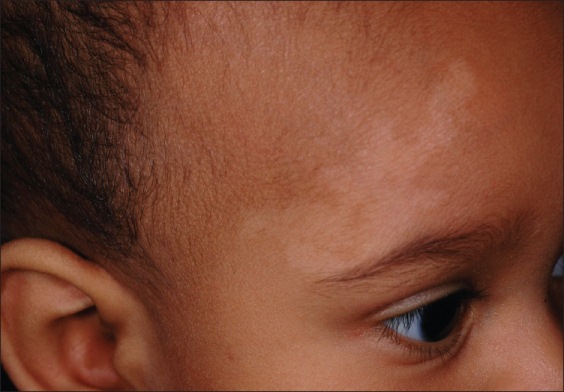 What About This Light Colored Patch Over An Infant s Brow Rules Out What About This Light Colored Patch Over An Infant s Brow Rules Out
