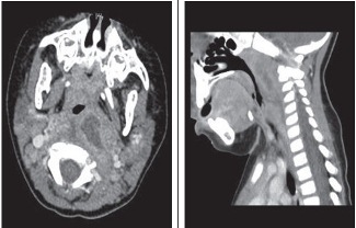 Retropharyngeal abscess