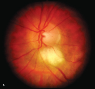 Myelinated Nerve Fibers